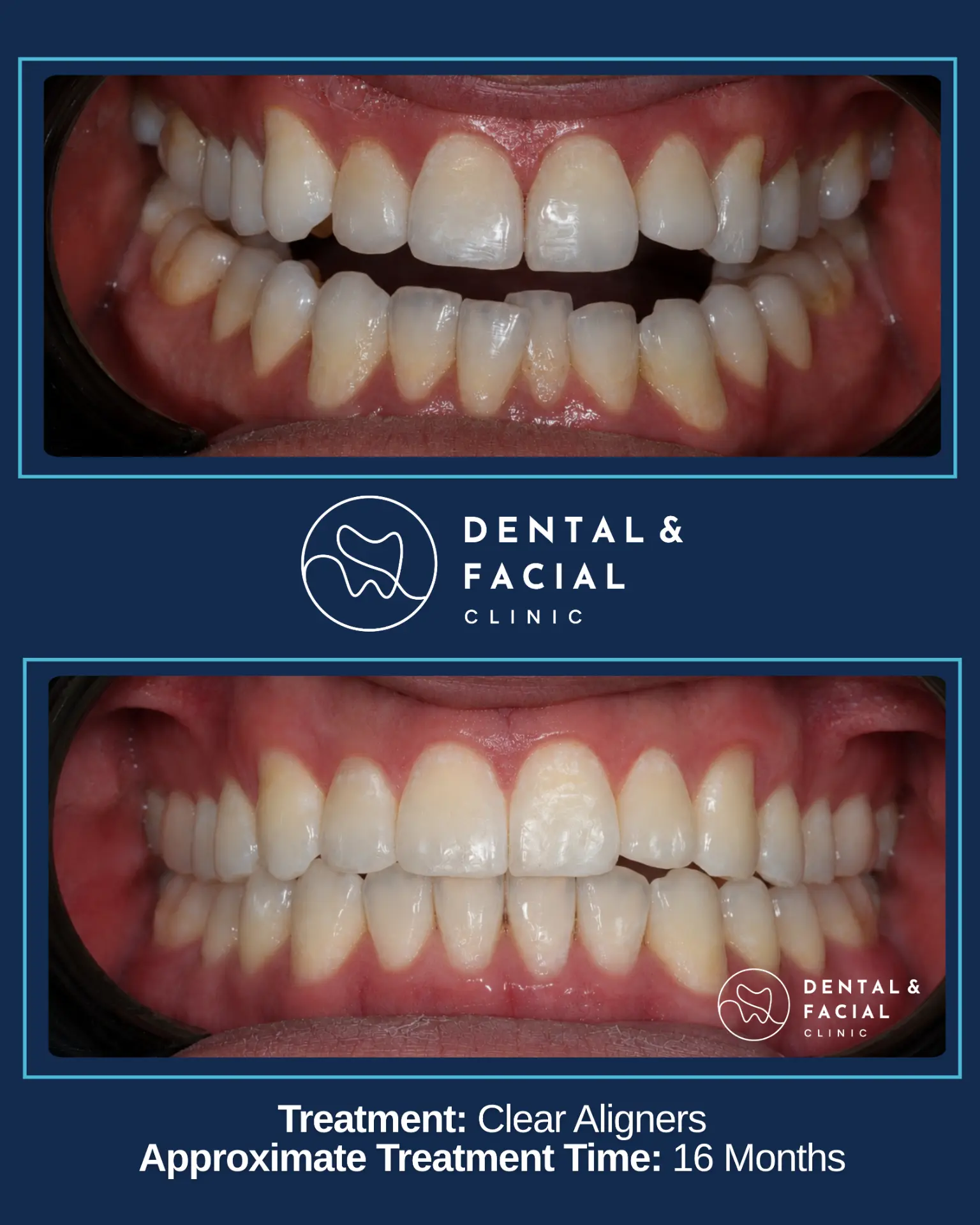 Before and after orthodontic treatment: Clear Aligners — 16 Months