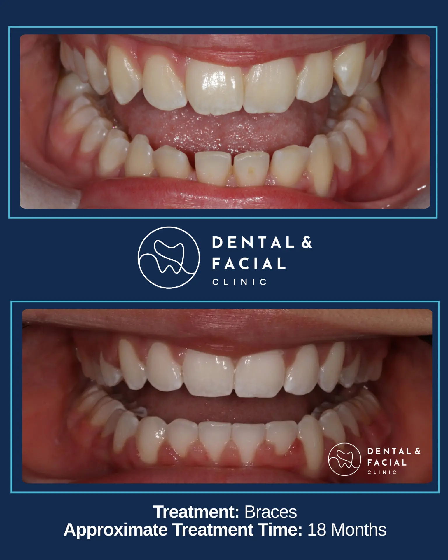 Before and after orthodontic treatment: Braces — 18 Months