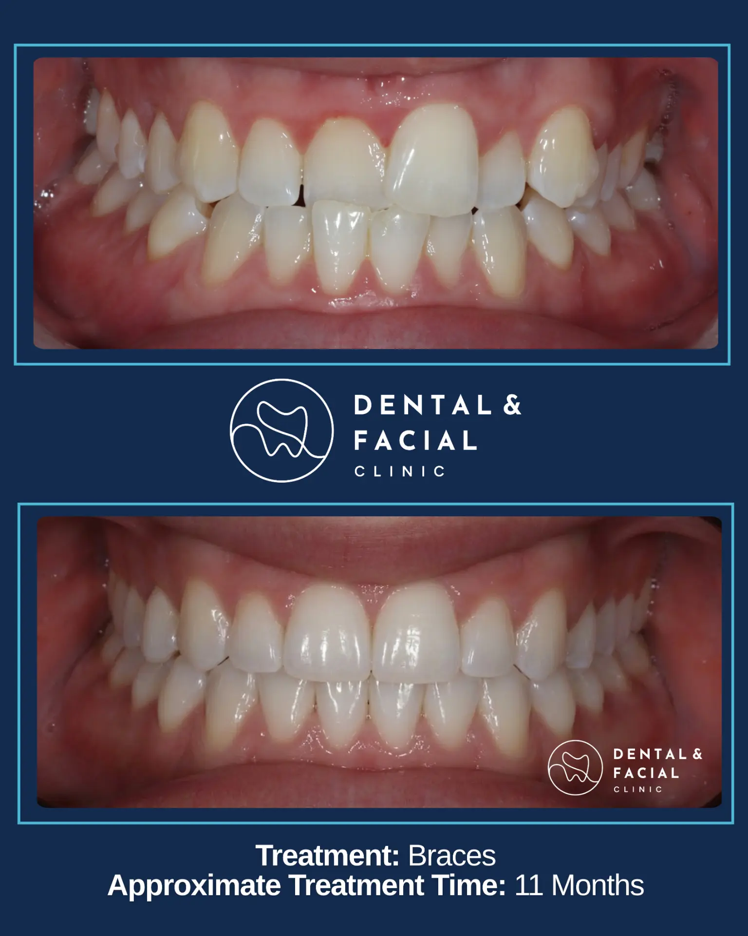 Before and after orthodontic treatment: Braces — 11 Months