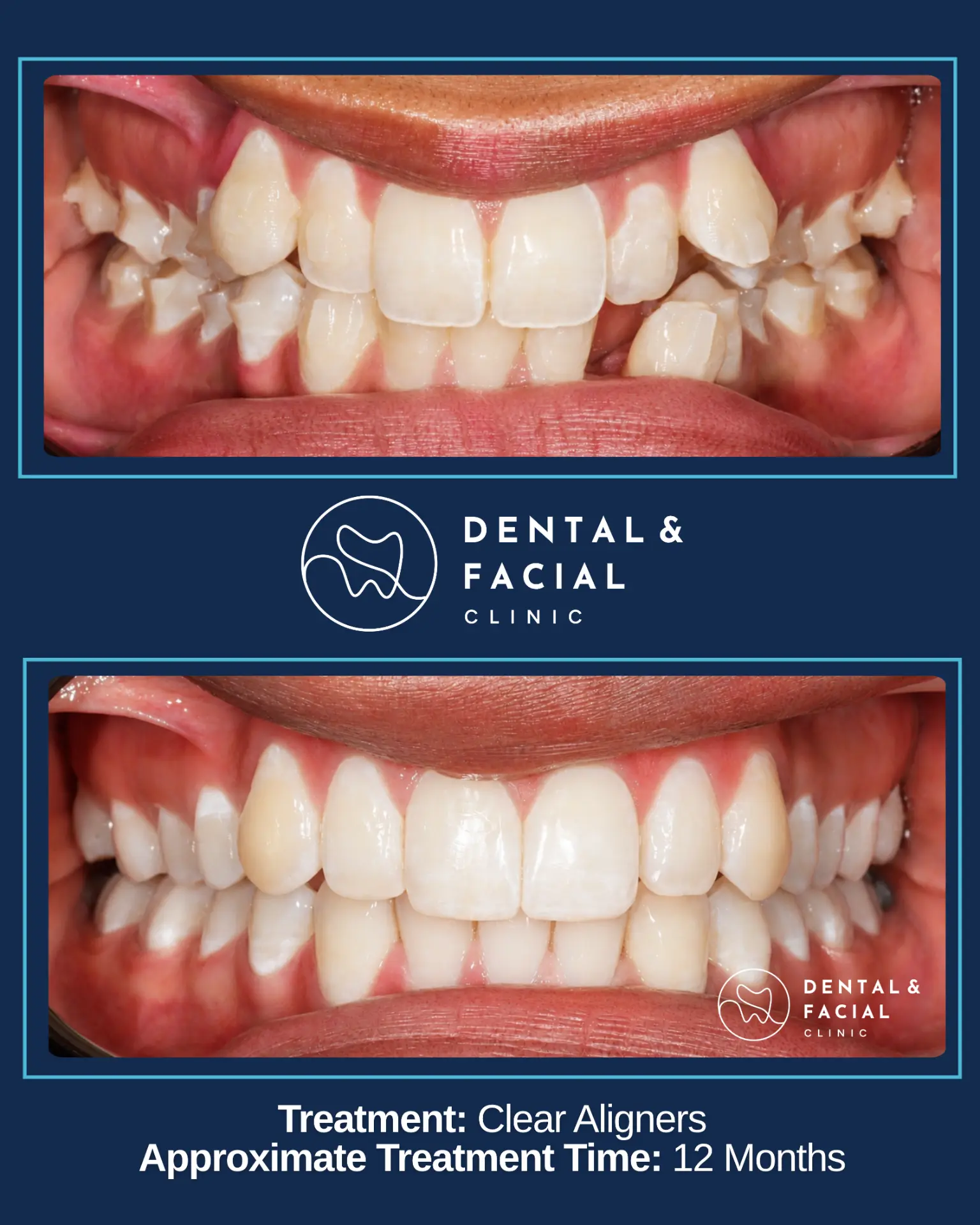 Before and after orthodontic treatment: Clear Aligners — 12 Months